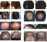 Hair Regrowth Solution Spray
