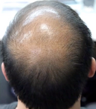 Volumon Hair Building Fibres - KERATIN 28g - For Men & Women!